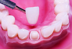 Porcelain Crowns - Canton Dental